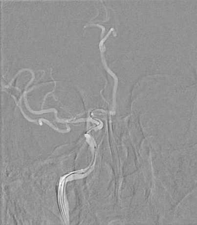 导丝怎么扩【载药时代 球扩天下】NOVA DES®颅内药物洗脱支架在颈内动脉颅内段重度狭窄中的应用体会二例！_https://www.jmylbn.com_新闻资讯_第28张