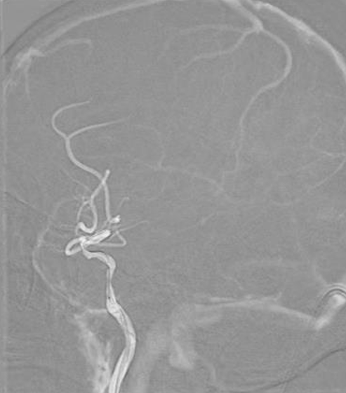 导丝怎么扩【载药时代 球扩天下】NOVA DES®颅内药物洗脱支架在颈内动脉颅内段重度狭窄中的应用体会二例！_https://www.jmylbn.com_新闻资讯_第25张