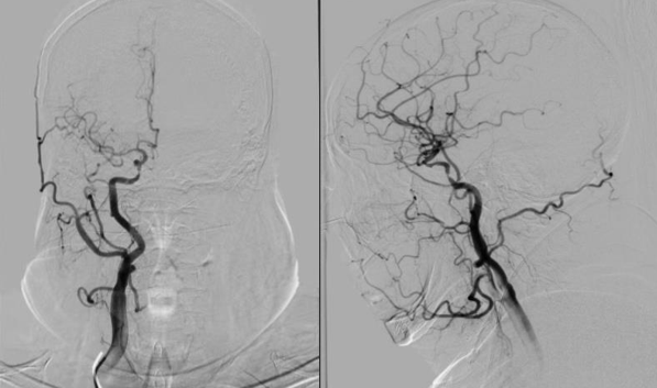导丝怎么扩【载药时代 球扩天下】NOVA DES®颅内药物洗脱支架在颈内动脉颅内段重度狭窄中的应用体会二例！_https://www.jmylbn.com_新闻资讯_第20张