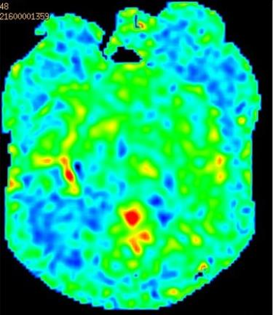 导丝怎么扩【载药时代 球扩天下】NOVA DES®颅内药物洗脱支架在颈内动脉颅内段重度狭窄中的应用体会二例！_https://www.jmylbn.com_新闻资讯_第17张