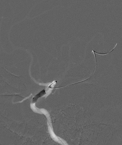 导丝怎么扩【载药时代 球扩天下】NOVA DES®颅内药物洗脱支架在颈内动脉颅内段重度狭窄中的应用体会二例！_https://www.jmylbn.com_新闻资讯_第9张