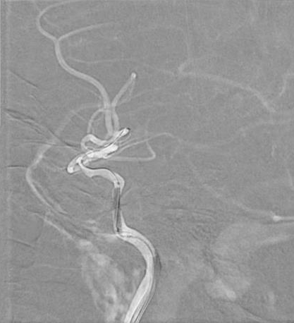 导丝怎么扩【载药时代 球扩天下】NOVA DES®颅内药物洗脱支架在颈内动脉颅内段重度狭窄中的应用体会二例！_https://www.jmylbn.com_新闻资讯_第29张