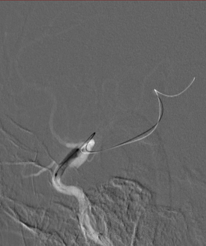 导丝怎么扩【载药时代 球扩天下】NOVA DES®颅内药物洗脱支架在颈内动脉颅内段重度狭窄中的应用体会二例！_https://www.jmylbn.com_新闻资讯_第12张
