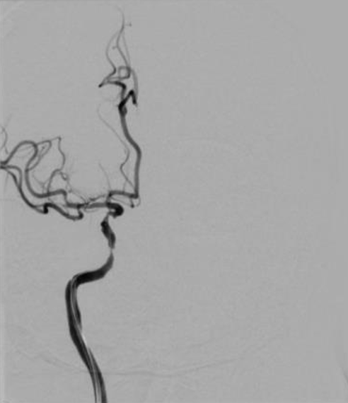 导丝怎么扩【载药时代 球扩天下】NOVA DES®颅内药物洗脱支架在颈内动脉颅内段重度狭窄中的应用体会二例！_https://www.jmylbn.com_新闻资讯_第24张