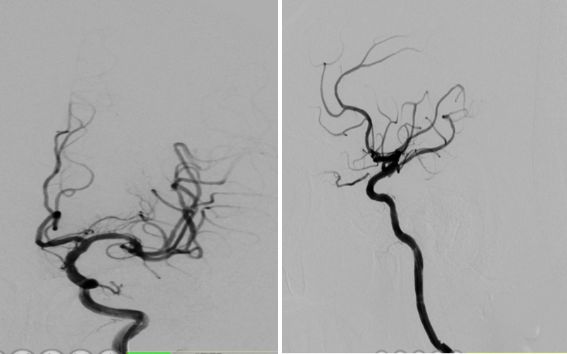 导丝怎么扩【载药时代 球扩天下】NOVA DES®颅内药物洗脱支架在颈内动脉颅内段重度狭窄中的应用体会二例！_https://www.jmylbn.com_新闻资讯_第14张