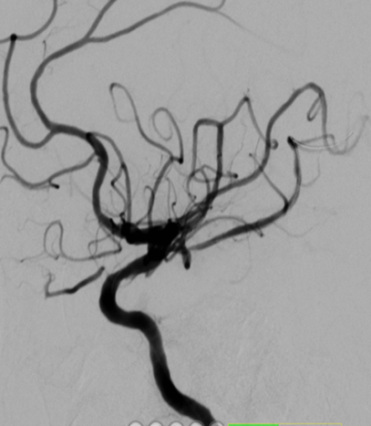 导丝怎么扩【载药时代 球扩天下】NOVA DES®颅内药物洗脱支架在颈内动脉颅内段重度狭窄中的应用体会二例！_https://www.jmylbn.com_新闻资讯_第10张
