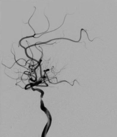 导丝怎么扩【载药时代 球扩天下】NOVA DES®颅内药物洗脱支架在颈内动脉颅内段重度狭窄中的应用体会二例！_https://www.jmylbn.com_新闻资讯_第27张