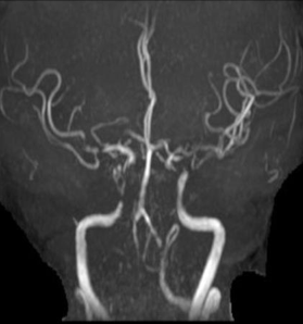 导丝怎么扩【载药时代 球扩天下】NOVA DES®颅内药物洗脱支架在颈内动脉颅内段重度狭窄中的应用体会二例！_https://www.jmylbn.com_新闻资讯_第19张