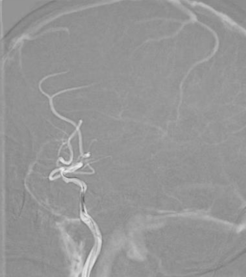 导丝怎么扩【载药时代 球扩天下】NOVA DES®颅内药物洗脱支架在颈内动脉颅内段重度狭窄中的应用体会二例！_https://www.jmylbn.com_新闻资讯_第26张