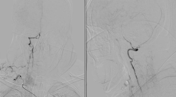 导丝怎么扩【载药时代 球扩天下】NOVA DES®颅内药物洗脱支架在颈内动脉颅内段重度狭窄中的应用体会二例！_https://www.jmylbn.com_新闻资讯_第22张