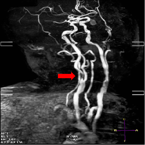 什么叫桡鞘【例久弥新】寻道于桡——瑞康通5.5F Introsky X导管鞘经桡入路治疗颈动脉重度狭窄一例_https://www.jmylbn.com_新闻资讯_第6张