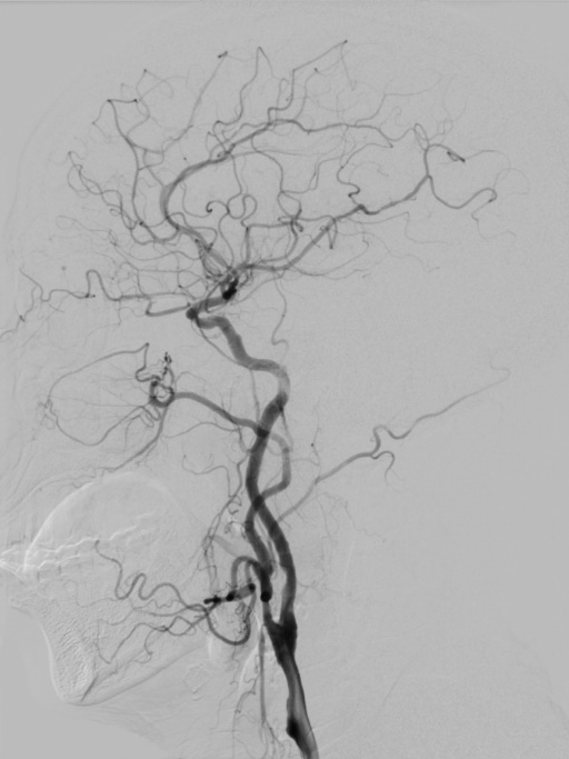 什么叫桡鞘【例久弥新】寻道于桡——瑞康通5.5F Introsky X导管鞘经桡入路治疗颈动脉重度狭窄一例_https://www.jmylbn.com_新闻资讯_第20张
