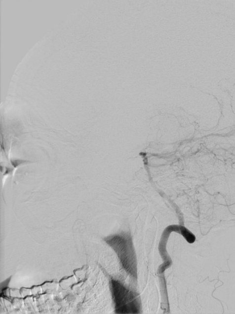 什么叫桡鞘【例久弥新】寻道于桡——瑞康通5.5F Introsky X导管鞘经桡入路治疗颈动脉重度狭窄一例_https://www.jmylbn.com_新闻资讯_第22张
