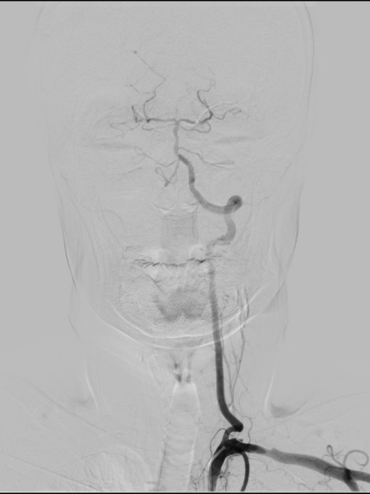 什么叫桡鞘【例久弥新】寻道于桡——瑞康通5.5F Introsky X导管鞘经桡入路治疗颈动脉重度狭窄一例_https://www.jmylbn.com_新闻资讯_第21张