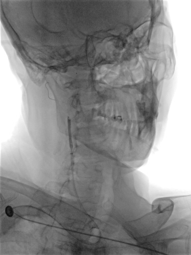 什么叫桡鞘【例久弥新】寻道于桡——瑞康通5.5F Introsky X导管鞘经桡入路治疗颈动脉重度狭窄一例_https://www.jmylbn.com_新闻资讯_第23张