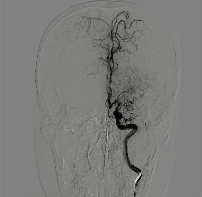 导丝怎么扩【载药时代 球扩天下】NOVA DES®颅内药物洗脱支架在颅内富穿支区域使用体会二例！_https://www.jmylbn.com_新闻资讯_第3张