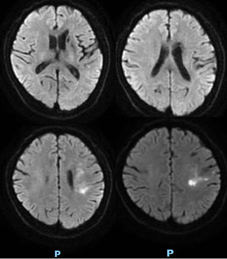 导丝怎么扩【载药时代 球扩天下】NOVA DES®颅内药物洗脱支架在颅内富穿支区域使用体会二例！_https://www.jmylbn.com_新闻资讯_第7张