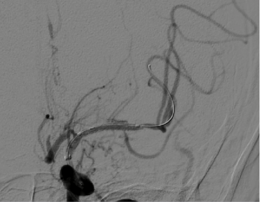 导丝怎么扩【载药时代 球扩天下】NOVA DES®颅内药物洗脱支架在颅内富穿支区域使用体会二例！_https://www.jmylbn.com_新闻资讯_第20张