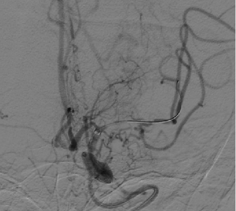 导丝怎么扩【载药时代 球扩天下】NOVA DES®颅内药物洗脱支架在颅内富穿支区域使用体会二例！_https://www.jmylbn.com_新闻资讯_第14张