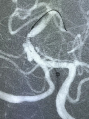 导丝怎么扩【载药时代 球扩天下】NOVA DES®颅内药物洗脱支架在颅内富穿支区域使用体会二例！_https://www.jmylbn.com_新闻资讯_第31张