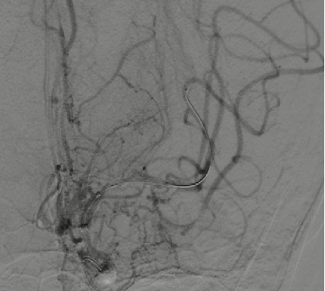 导丝怎么扩【载药时代 球扩天下】NOVA DES®颅内药物洗脱支架在颅内富穿支区域使用体会二例！_https://www.jmylbn.com_新闻资讯_第18张