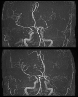 导丝怎么扩【载药时代 球扩天下】NOVA DES®颅内药物洗脱支架在颅内富穿支区域使用体会二例！_https://www.jmylbn.com_新闻资讯_第10张