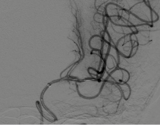 导丝怎么扩【载药时代 球扩天下】NOVA DES®颅内药物洗脱支架在颅内富穿支区域使用体会二例！_https://www.jmylbn.com_新闻资讯_第16张