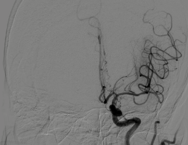 导丝怎么扩【载药时代 球扩天下】NOVA DES®颅内药物洗脱支架在颅内富穿支区域使用体会二例！_https://www.jmylbn.com_新闻资讯_第22张