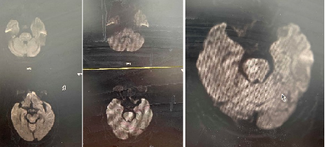 导丝怎么扩【载药时代 球扩天下】NOVA DES®颅内药物洗脱支架在颅内富穿支区域使用体会二例！_https://www.jmylbn.com_新闻资讯_第28张