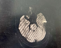 导丝怎么扩【载药时代 球扩天下】NOVA DES®颅内药物洗脱支架在颅内富穿支区域使用体会二例！_https://www.jmylbn.com_新闻资讯_第25张