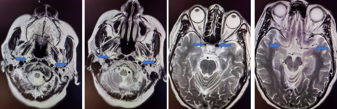 导丝怎么扩【载药时代 球扩天下】NOVA DES®颅内药物洗脱支架在大脑中动脉重度狭窄的应用二例！_https://www.jmylbn.com_新闻资讯_第4张