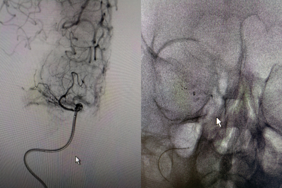 导丝怎么扩【载药时代 球扩天下】NOVA DES®颅内药物洗脱支架在大脑中动脉重度狭窄的应用二例！_https://www.jmylbn.com_新闻资讯_第13张