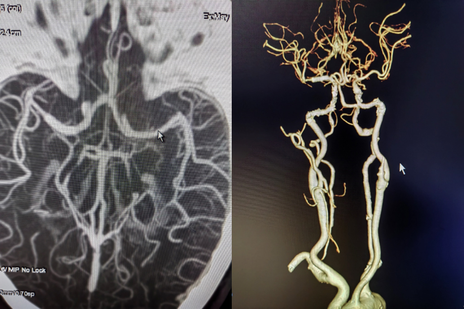 导丝怎么扩【载药时代 球扩天下】NOVA DES®颅内药物洗脱支架在大脑中动脉重度狭窄的应用二例！_https://www.jmylbn.com_新闻资讯_第20张
