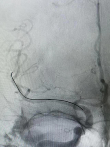 导丝怎么扩【载药时代 球扩天下】NOVA DES®颅内药物洗脱支架在大脑中动脉重度狭窄的应用二例！_https://www.jmylbn.com_新闻资讯_第25张