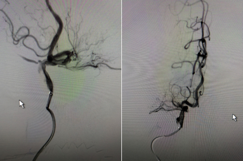 导丝怎么扩【载药时代 球扩天下】NOVA DES®颅内药物洗脱支架在大脑中动脉重度狭窄的应用二例！_https://www.jmylbn.com_新闻资讯_第12张