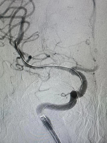 导丝怎么扩【载药时代 球扩天下】NOVA DES®颅内药物洗脱支架在大脑中动脉重度狭窄的应用二例！_https://www.jmylbn.com_新闻资讯_第24张