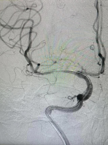 导丝怎么扩【载药时代 球扩天下】NOVA DES®颅内药物洗脱支架在大脑中动脉重度狭窄的应用二例！_https://www.jmylbn.com_新闻资讯_第27张