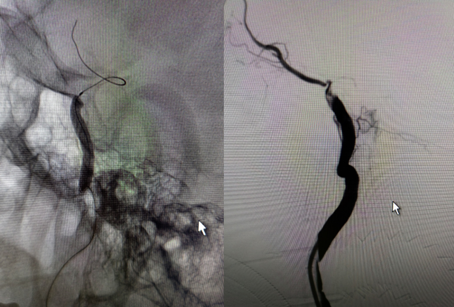 导丝怎么扩【载药时代 球扩天下】NOVA DES®颅内药物洗脱支架在大脑中动脉重度狭窄的应用二例！_https://www.jmylbn.com_新闻资讯_第11张