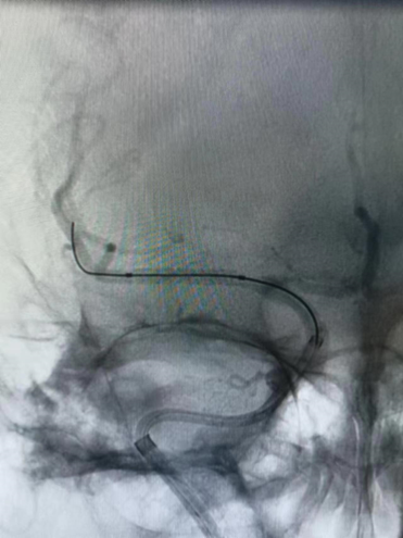 导丝怎么扩【载药时代 球扩天下】NOVA DES®颅内药物洗脱支架在大脑中动脉重度狭窄的应用二例！_https://www.jmylbn.com_新闻资讯_第29张