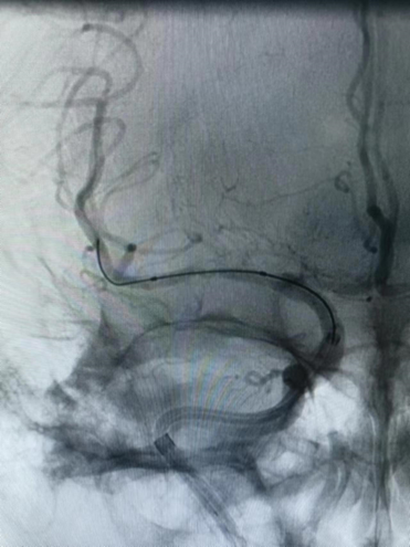 导丝怎么扩【载药时代 球扩天下】NOVA DES®颅内药物洗脱支架在大脑中动脉重度狭窄的应用二例！_https://www.jmylbn.com_新闻资讯_第28张