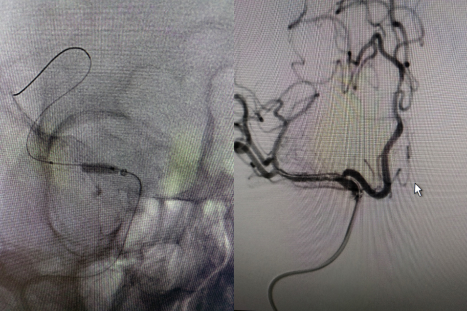 导丝怎么扩【载药时代 球扩天下】NOVA DES®颅内药物洗脱支架在大脑中动脉重度狭窄的应用二例！_https://www.jmylbn.com_新闻资讯_第15张