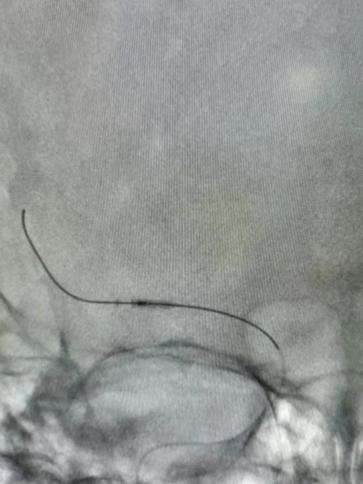 导丝怎么扩【载药时代 球扩天下】NOVA DES®颅内药物洗脱支架在大脑中动脉重度狭窄的应用二例！_https://www.jmylbn.com_新闻资讯_第26张