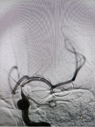 导丝怎么扩【载药时代 球扩天下】NOVA DES®颅内药物洗脱支架在颈内动脉颅内段重度狭窄的应用两例！滕州市中心医院&山西医科大学第二医院_https://www.jmylbn.com_新闻资讯_第6张