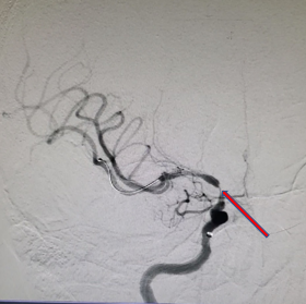 导丝怎么扩【载药时代 球扩天下】NOVA DES®颅内药物洗脱支架在颈内动脉颅内段重度狭窄的应用两例！滕州市中心医院&山西医科大学第二医院_https://www.jmylbn.com_新闻资讯_第17张