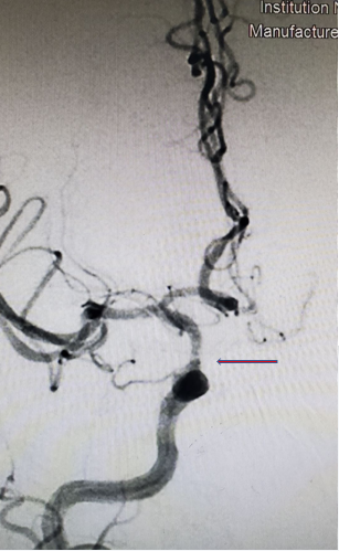 导丝怎么扩【载药时代 球扩天下】NOVA DES®颅内药物洗脱支架在颈内动脉颅内段重度狭窄的应用两例！滕州市中心医院&山西医科大学第二医院_https://www.jmylbn.com_新闻资讯_第22张