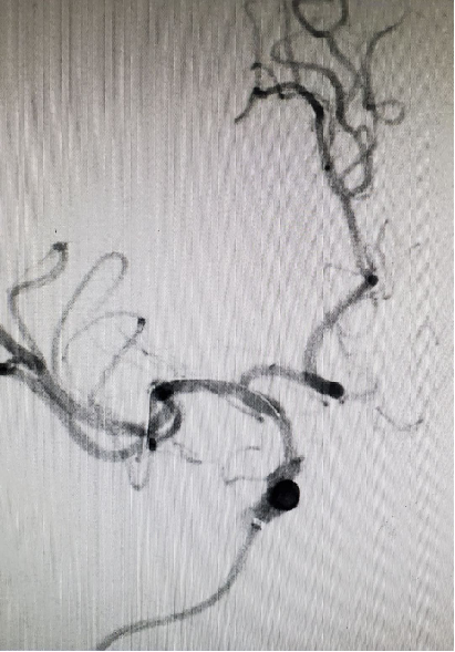 导丝怎么扩【载药时代 球扩天下】NOVA DES®颅内药物洗脱支架在颈内动脉颅内段重度狭窄的应用两例！滕州市中心医院&山西医科大学第二医院_https://www.jmylbn.com_新闻资讯_第20张