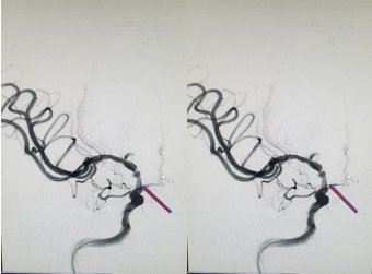 导丝怎么扩【载药时代 球扩天下】NOVA DES®颅内药物洗脱支架在颈内动脉颅内段重度狭窄的应用两例！滕州市中心医院&山西医科大学第二医院_https://www.jmylbn.com_新闻资讯_第18张
