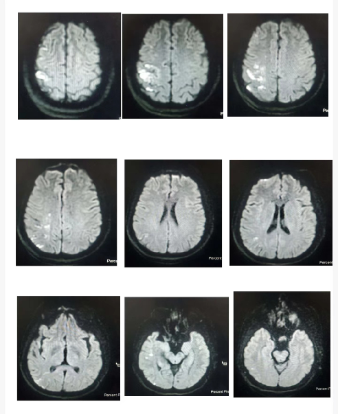 导丝怎么扩【载药时代 球扩天下】NOVA DES®颅内药物洗脱支架在颈内动脉颅内段重度狭窄的应用两例！滕州市中心医院&山西医科大学第二医院_https://www.jmylbn.com_新闻资讯_第13张