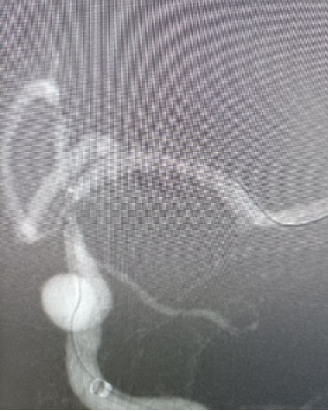 导丝怎么扩【载药时代 球扩天下】NOVA DES®颅内药物洗脱支架在颈内动脉颅内段重度狭窄的应用两例！滕州市中心医院&山西医科大学第二医院_https://www.jmylbn.com_新闻资讯_第8张
