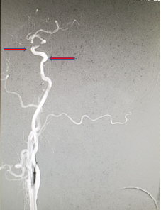 导丝怎么扩【载药时代 球扩天下】NOVA DES®颅内药物洗脱支架在颈内动脉颅内段重度狭窄的应用两例！滕州市中心医院&山西医科大学第二医院_https://www.jmylbn.com_新闻资讯_第16张